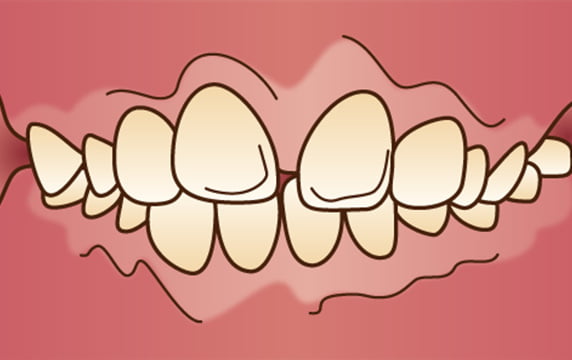 出っ歯（上顎前突）イメージ画像