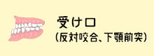 受け口（反対咬合、下顎前突）