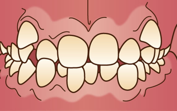 出っ歯（上顎前突）イメージ画像