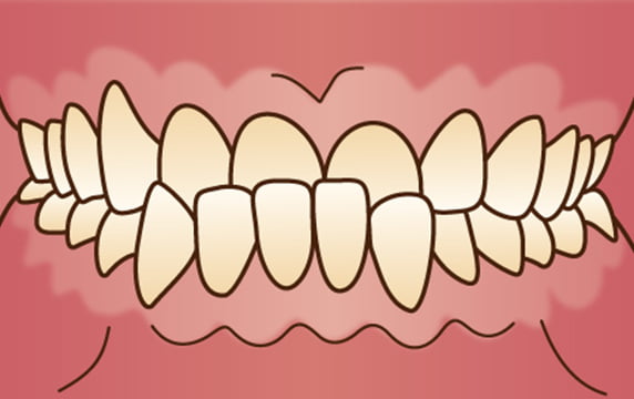 受け口（反対咬合、下顎前突）イメージ画像